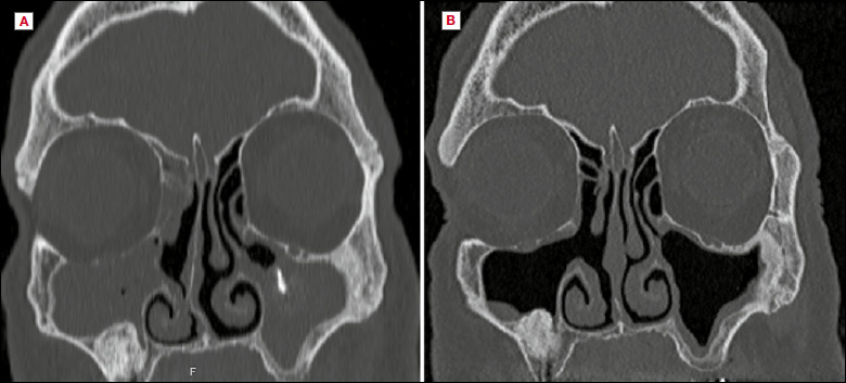 Ostiomeatal complex preservation: submucosal inferior meatal antrostomy for maxillary sinus pathologies.