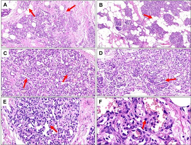 Large atypical perilobular hemangioma in the breast: a potential misdiagnosis as angiosarcoma.