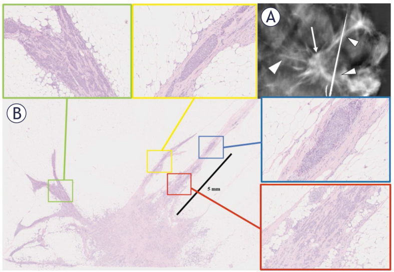 Mammographically detected spicules associated with malignant breast tumors frequently harbor additional tumor foci.