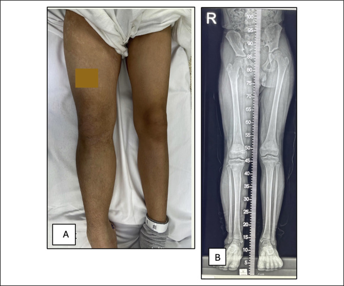 Confounding Association of Lower Limb Hypertrophy With Retarded Long Bone Growth in Mosaic Somatic Neurofibromatosis 1-A Genetic Review and Femoral Lengthening Treatment.