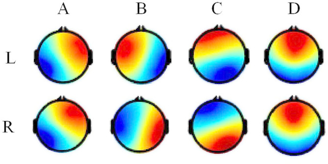 Classification of left and right-hand motor imagery in acute stroke patients using EEG microstate.