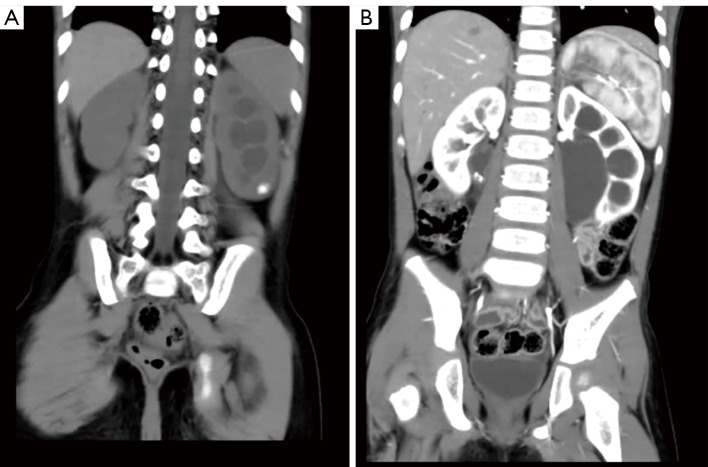 Comparison of robot-assisted and laparoscopic pyeloplasty with flexible ureteroscopy for managing concomitant ureteropelvic junction obstruction and renal calculi in children.