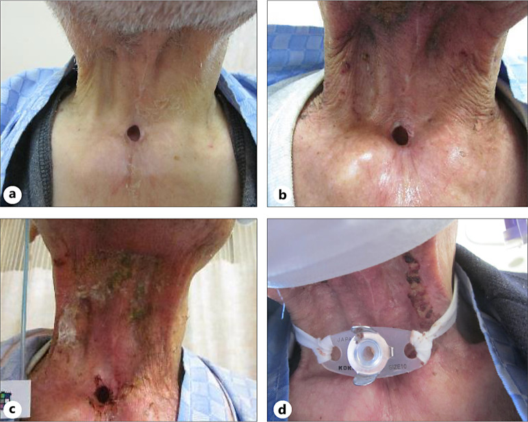 Changes in the Skin Microbiome of a Patient with Head and Neck Cancer with Severe Radiodermatitis: A Case Report.