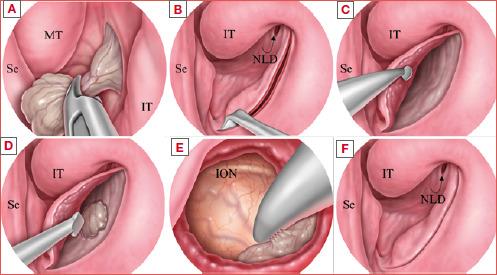 Ostiomeatal complex preservation: submucosal inferior meatal antrostomy for maxillary sinus pathologies.