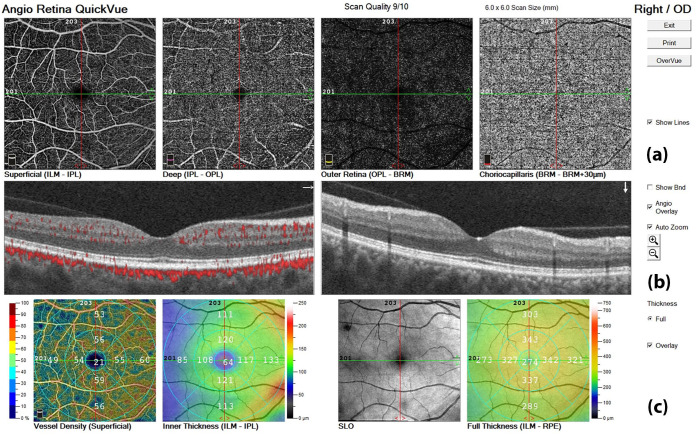 Evaluating the impact of anti-CGRP monoclonal antibodies on retinal features in migraine patients: a retrospective optical coherence tomography study.