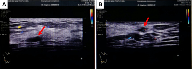 Large atypical perilobular hemangioma in the breast: a potential misdiagnosis as angiosarcoma.