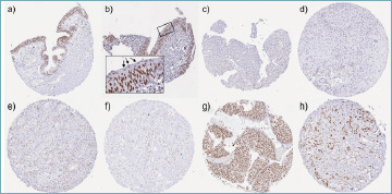 KDM6A expression loss is frequent in low grade non-invasive urothelial carcinomas of the urinary bladder.