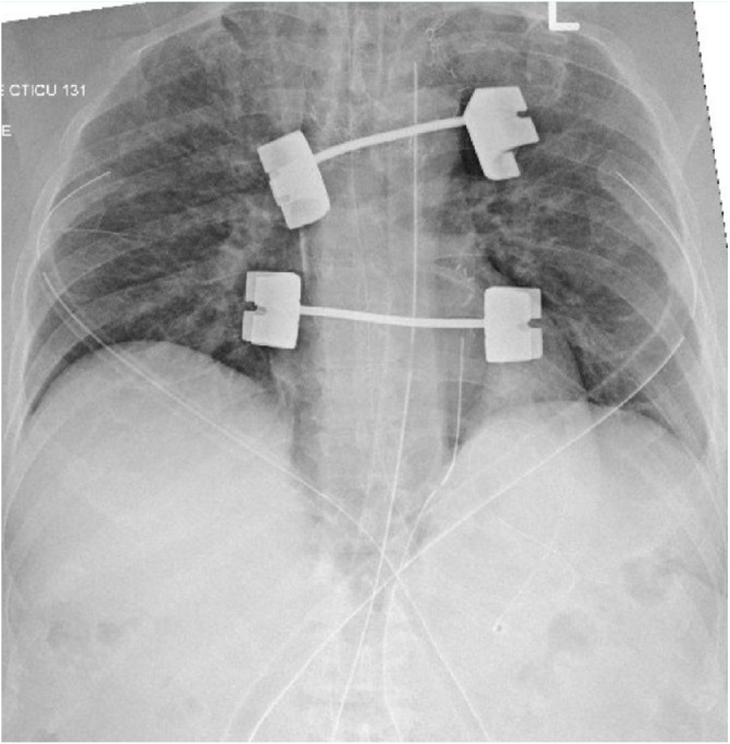 Re-expansion pulmonary edema after routine use of cardiopulmonary bypass in cardiac surgery: Case report.