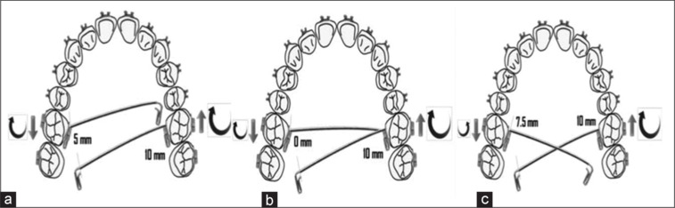 Finite element analysis of the transpalatal arch force systems activated in the Burstone geometries with different materials.