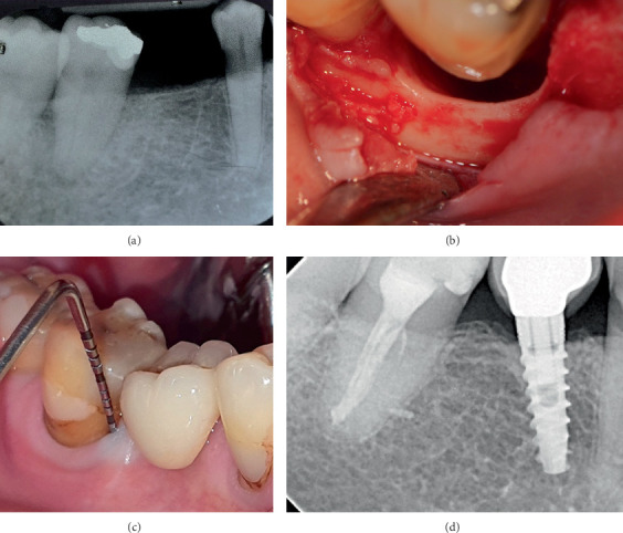 Long-Term Benefits of Periodontal Regeneration in Severely Compromised Teeth: A Retrospective Case Series.