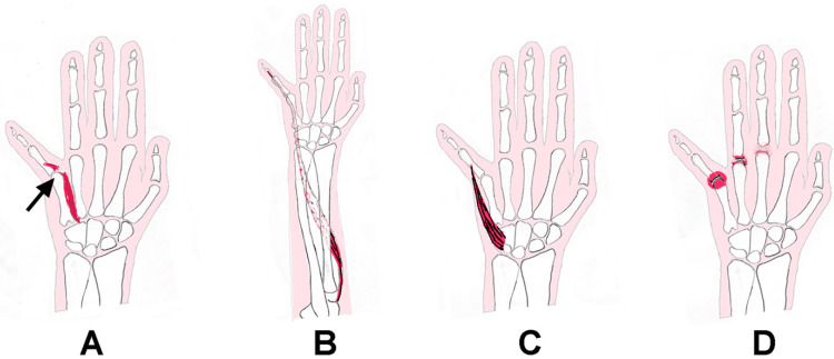 A Retrospective Study of 10 Patients Exhibiting the "Pseudo Wartenberg Sign".