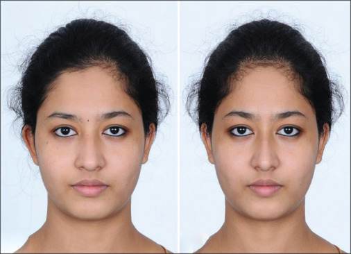 Chin asymmetry perception among orthodontists, general dentists, and laypersons.