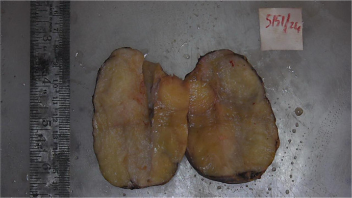 Adrenal Incidentaloma Masquerading as Malignancy: A Rare Case of Ganglioneuroma with Nodal Metastasis.