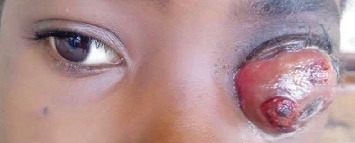 Retinoblastoma in a Young Nigerian Girl: A Case Report From ECWA Eye Hospital, Kano.