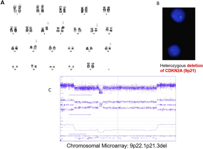 A Novel EP300 Variant in an African American Girl With Global Developmental Delay and Leukemia.