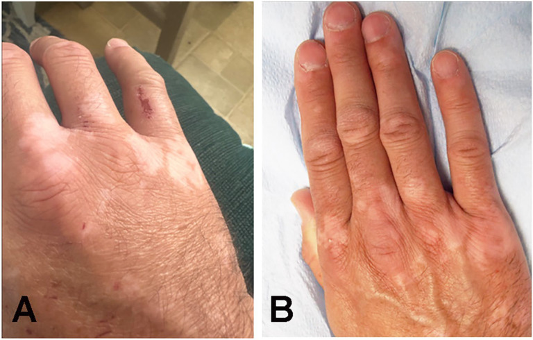 A Retrospective Study of 10 Patients Exhibiting the "Pseudo Wartenberg Sign".