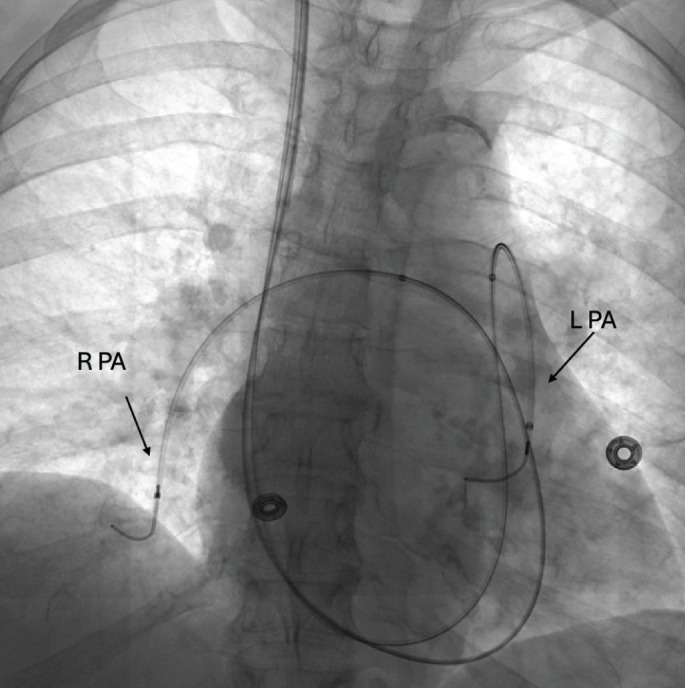 The latest in the management of pulmonary embolism.