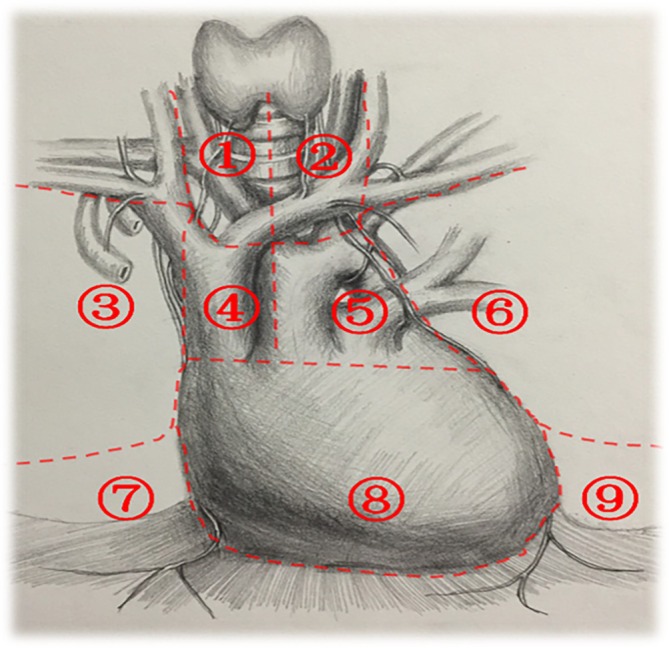 Expert Consensus on Subxiphoid and Subcostal Arch Thoracoscopic Resection for the Treatment of Thymoma.