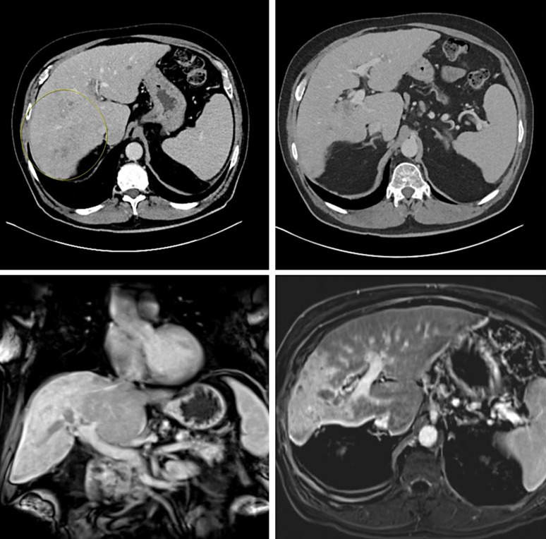 Rechallenging Unresectable Hepatocellular Carcinoma with the STRIDE Regimen: A Case Report of Significant AFP Response after Atezolizumab-Bevacizumab Intolerance.