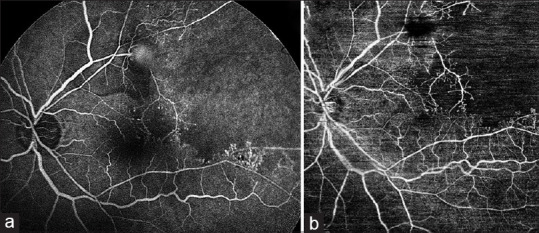 Resolution of the hole-related subclinical retinal detachment following barrage and sectorial laser photocoagulation in ischemic branch retinal vein occlusion.