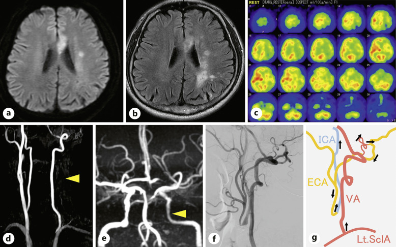 Subclavian Artery-Internal Carotid Artery Bypass Using a Radial Artery Graft for Common Carotid Artery Occlusion with Immediate Improvement of Cognitive Function: A Case Report.
