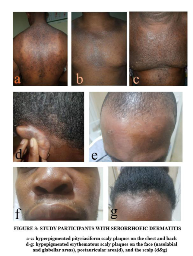 Clinical Profile of Seborrhoeic Dermatitis Patients Seen in a Tertiary Hospital in Lagos, Nigeria - A Case-Control Study.