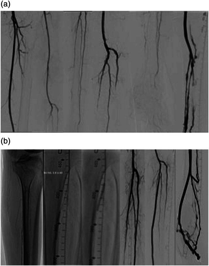 Intravascular lithotripsy-assisted percutaneous deep vein arterialization for no-option chronic limb-threatening patients and heavily calcified tibial occlusive disease.