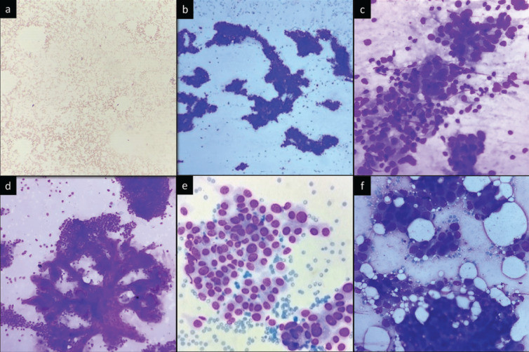 Categorization of Breast Fine Needle Aspirates Using Yokohama Classification and Its Correlation With Histopathological Findings.