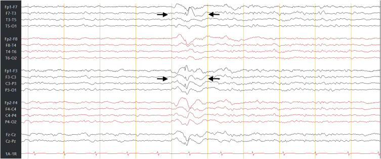 Recurrent Cerebrospinal Fluid Rhinorrhea Secondary to a Seizure-Induced Skull-Base Defect: An Unusual Complication of Epilepsy.