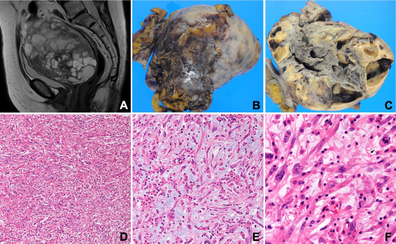 Heterochronic pelvic high-grade myxoinflammatory fibroblastic sarcoma and uterine endometroid carcinoma harboring common gene mutations: a rare case report with genomic analysis.