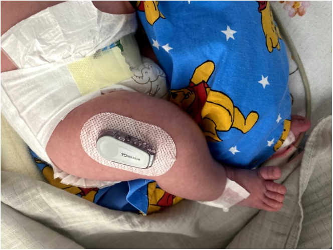 Continuous glucose monitoring in a neonate with hyperinsulinemic hypoglycemia and ABCC8 gene mutation.