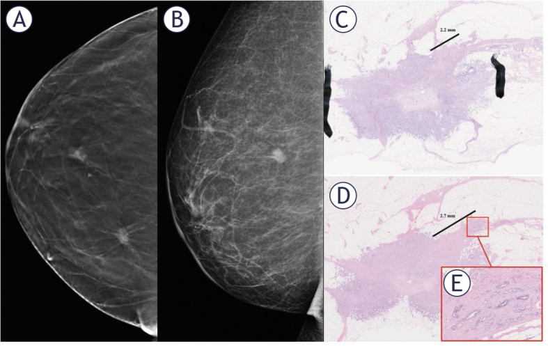 Mammographically detected spicules associated with malignant breast tumors frequently harbor additional tumor foci.