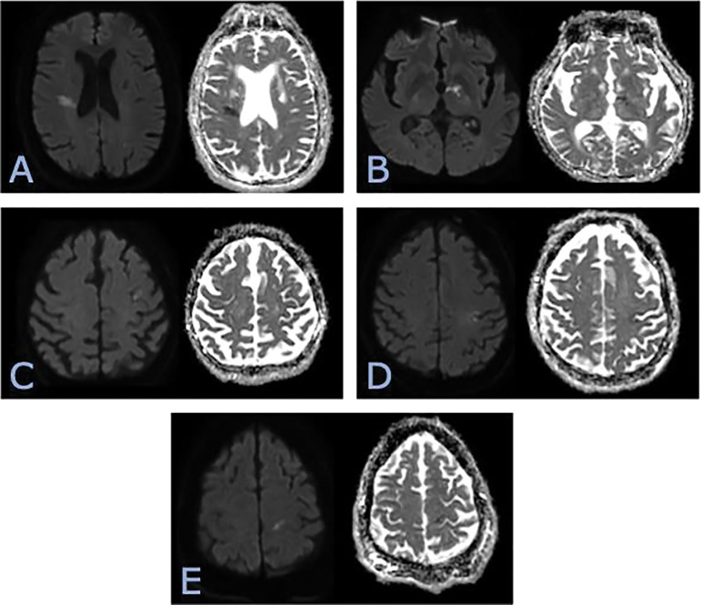 Availability & Applicability of the National Institute of Health Stroke Scale at Time of Imaging Interpretation for Code Stroke in the Community Hospital Setting.