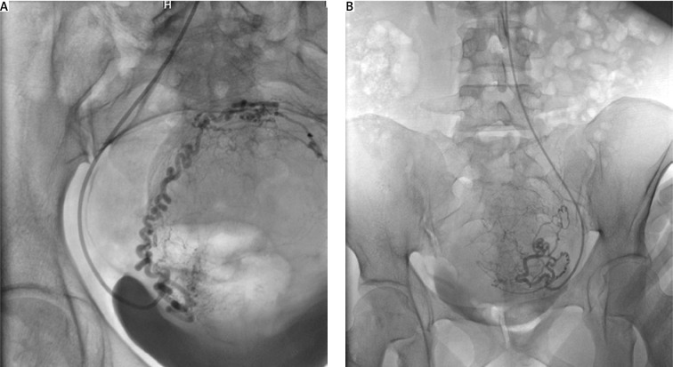 Successful consecutive pregnancies following two uterine artery embolization procedures for symptomatic fibroids.