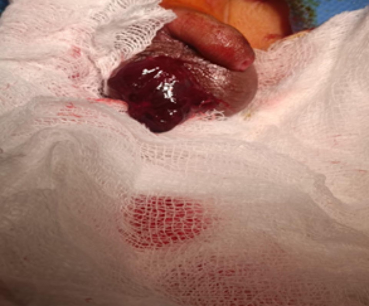 Neonatal Adrenal Haemorrhage Mimicking Acute Scrotum: A Case Report.