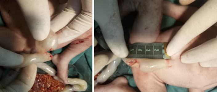 Fetal demise due to stab wound with umbilical cord transection: a case report.