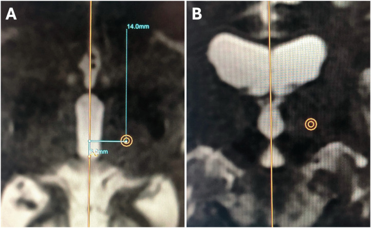 New technique for direct targeting of the ventral intermediate nucleus using magnetic resonance-guided focused ultrasound.