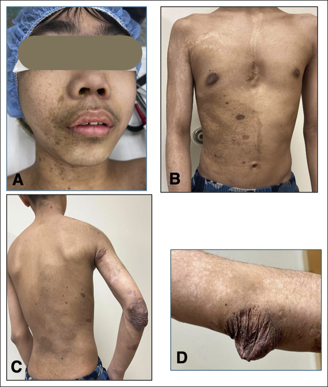 Confounding Association of Lower Limb Hypertrophy With Retarded Long Bone Growth in Mosaic Somatic Neurofibromatosis 1-A Genetic Review and Femoral Lengthening Treatment.