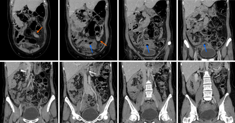 Retrospective analysis of computed tomography examinations in patients with lower abdominal pain: A single-center experience.