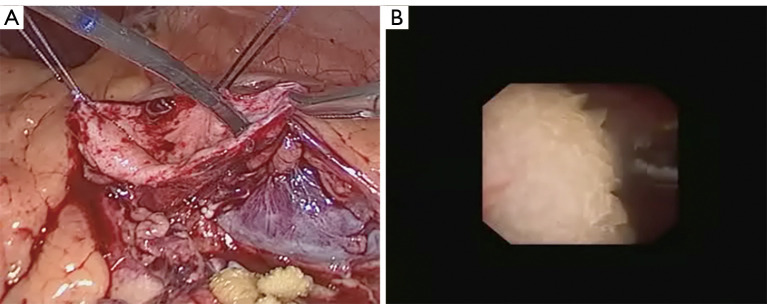Comparison of robot-assisted and laparoscopic pyeloplasty with flexible ureteroscopy for managing concomitant ureteropelvic junction obstruction and renal calculi in children.