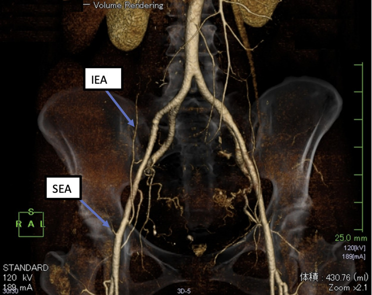 Large Hematoma Following Ultrasound-Guided Rectus Sheath Block.