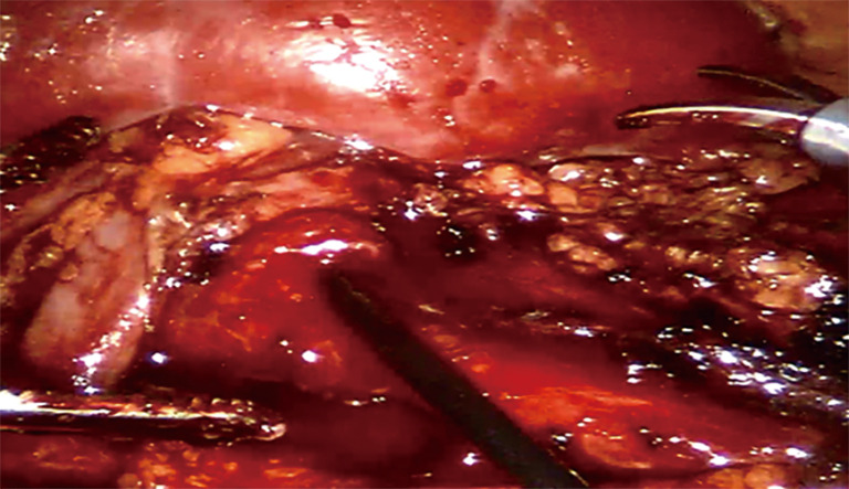 Comparison of robot-assisted and laparoscopic pyeloplasty with flexible ureteroscopy for managing concomitant ureteropelvic junction obstruction and renal calculi in children.