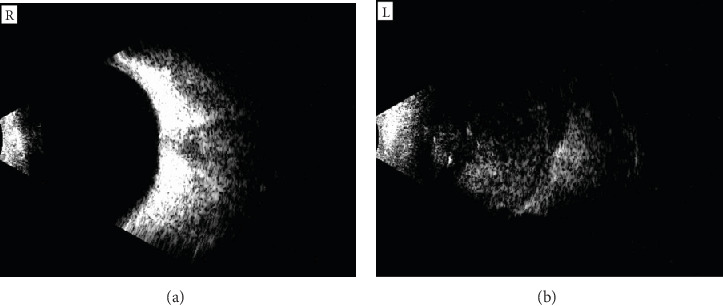 Retinoblastoma in a Young Nigerian Girl: A Case Report From ECWA Eye Hospital, Kano.