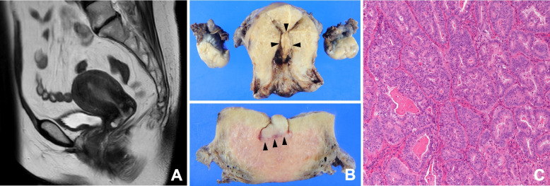 Heterochronic pelvic high-grade myxoinflammatory fibroblastic sarcoma and uterine endometroid carcinoma harboring common gene mutations: a rare case report with genomic analysis.