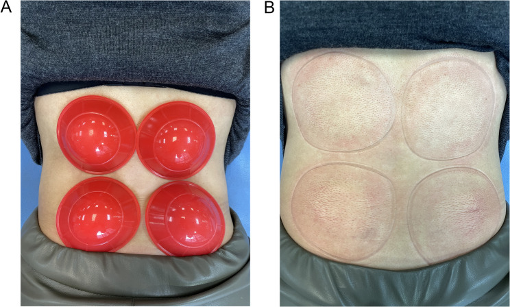 Dry cupping therapy combined with conventional therapy does not provide additional benefits over conventional therapy alone in patients with non-specific chronic low back pain: a randomized trial.