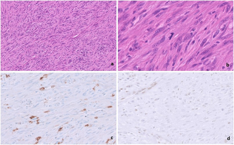 Radiation-Induced Intraosseous Malignant Peripheral Nerve Sheath Tumor: A Case Report.