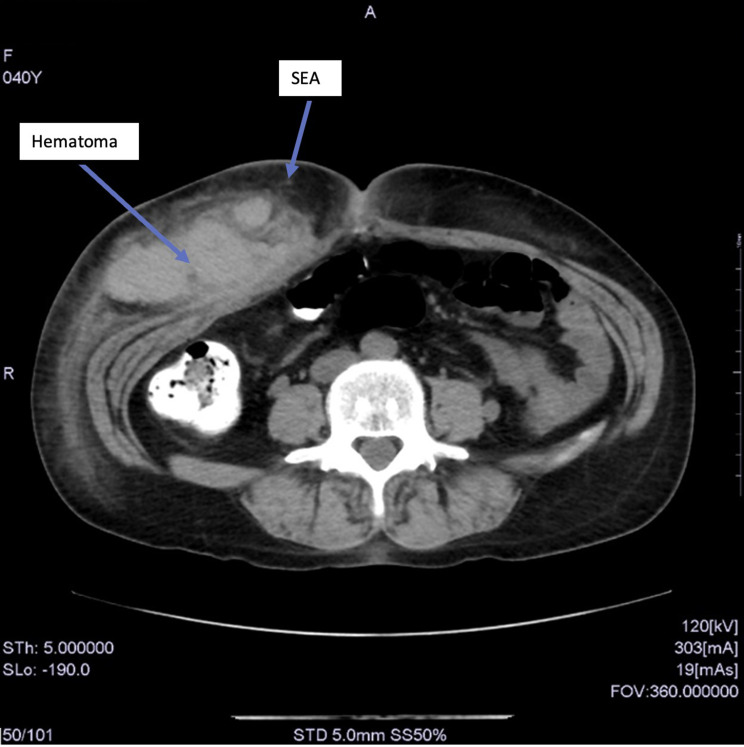 Large Hematoma Following Ultrasound-Guided Rectus Sheath Block.