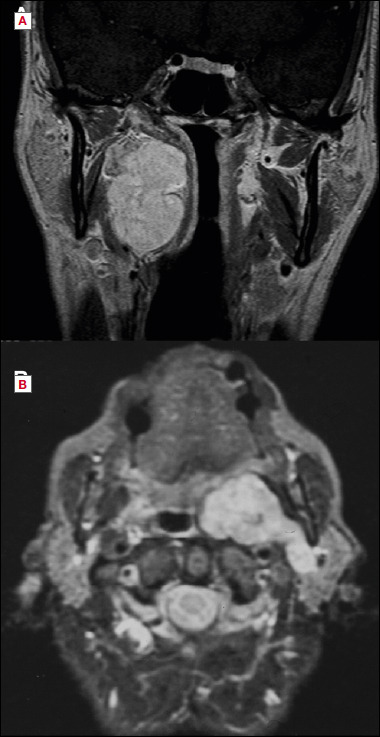 Microsurgery in primary tumours of the parapharyngeal space: observational retrospective analysis of a series of consecutive cases.