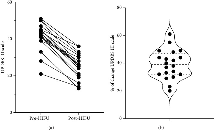 Predictive Value of Brain Volumetry in the Response to Subthalamotomy Using High-Intensity Focused Ultrasound Treatment in Patients With Parkinson's Disease.