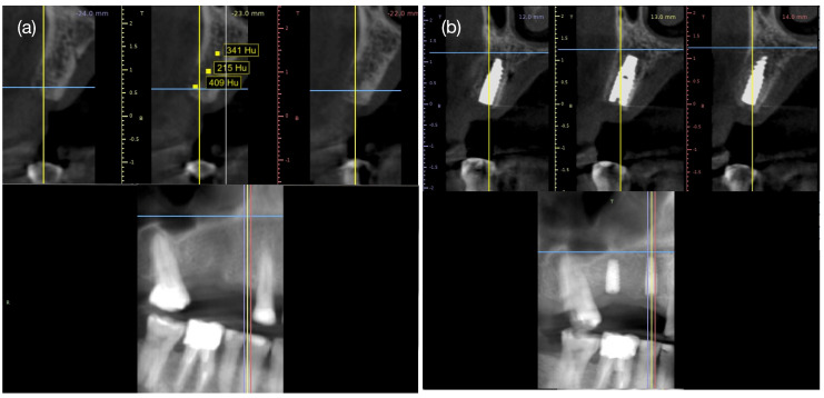 Alveolar Ridge Preservation Using Three-Dimensional Root Replicas of Polycaprolactone: A Radiological and Histological Evaluation of a Case Report.